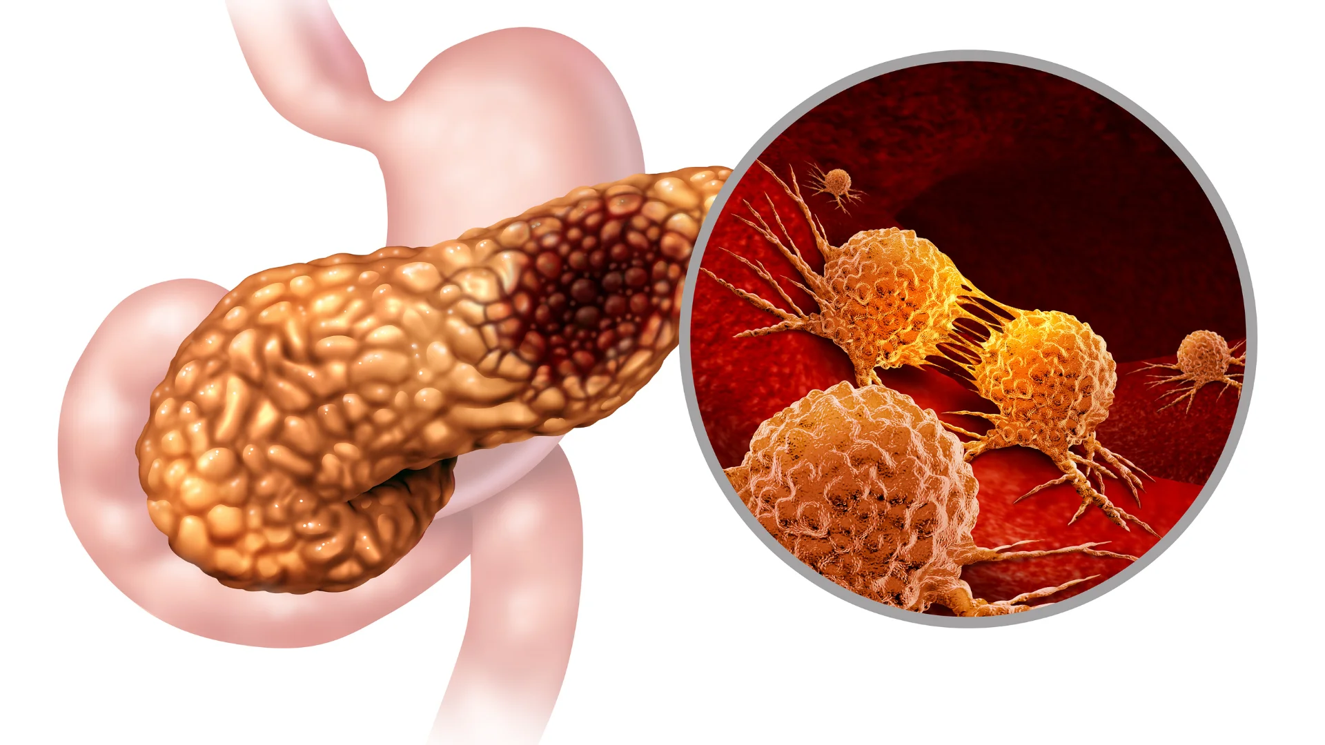 Pancreatic Cancer
